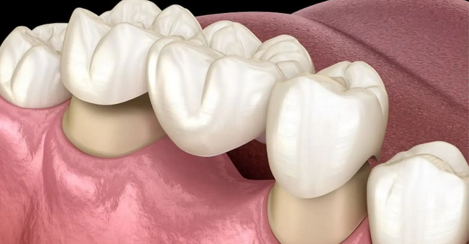 Why is a dental cantilever bridge not recommended 2